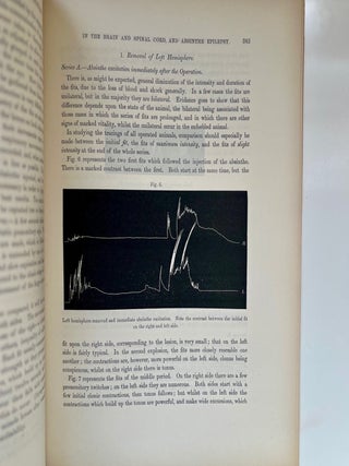 A Contribution to the Study of Descending Degenerations in the Brain and Spinal Cord, and of the... (5/9)